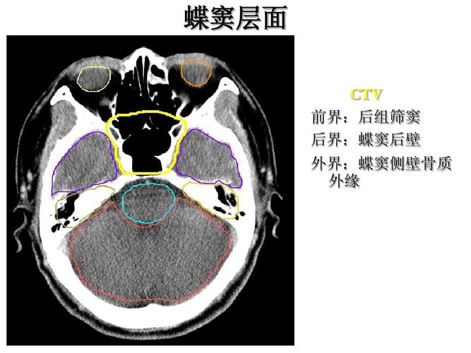蝶窦层面 ctv 前界:后组筛窦 后界:蝶窦后壁 外界:蝶窦侧壁骨质 外缘