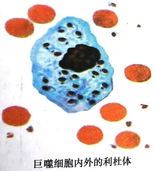 对一例内脏利什曼病的学习及思考