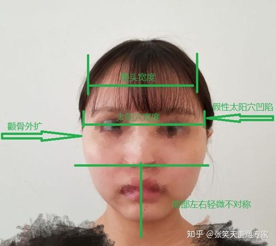 头大脸大颧骨高,整个脸不对称,削颧骨可以让脸看起来正常吗?