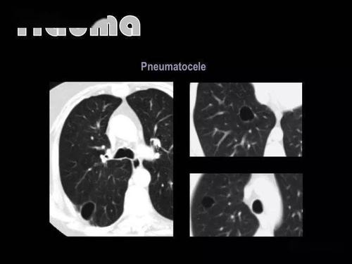 你报错了多少"肺气囊"?