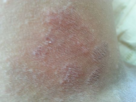 问:大腿根部有红斑,有点痒是怎么回事啊