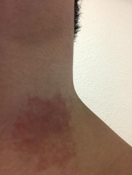 脖子上红的这一块是怎么弄的啊