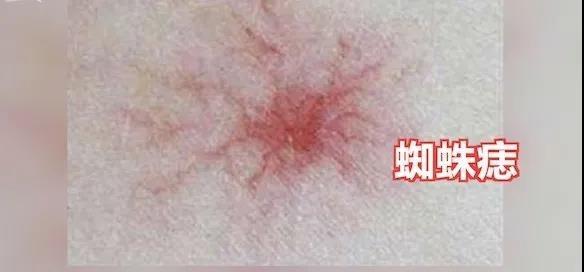 皮肤出现蜘蛛痣,或暗示肝脏病变,教你如何辨别,别太晚知道