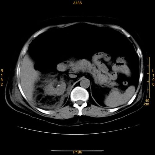 ct41502急性化脓性阑尾炎术后3天请分析