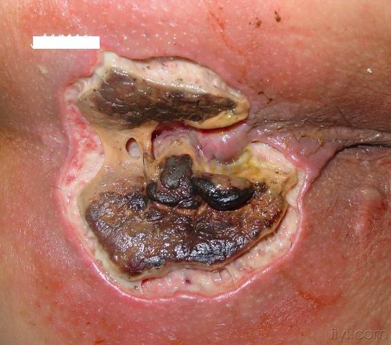 江湖游医导致肛门损伤(照片)