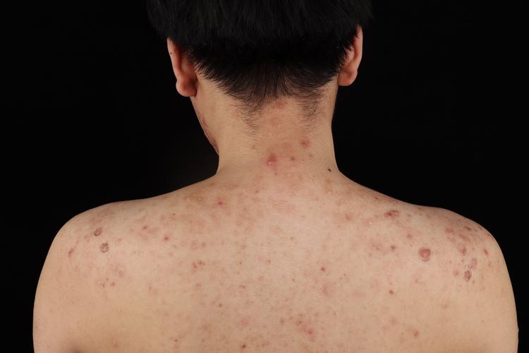 怎么知道自己是普通的痘痘还是瘢痕疙瘩?