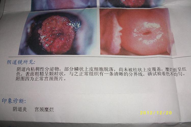 go龙飞凤舞999    2012-12-20 14:28 三度重度宫颈糜烂!