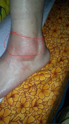 我被撞了左脚医生说脚关节有少量积水,一个