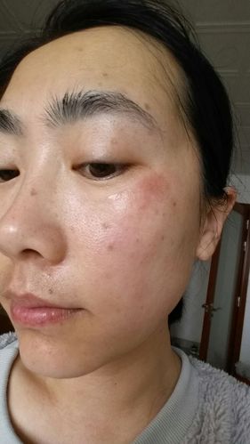 保湿水 活酵母 冻膜,拯救晒伤肌肤!