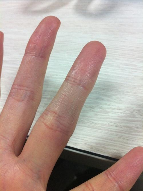 无名指突然淤血肿胀疼痛