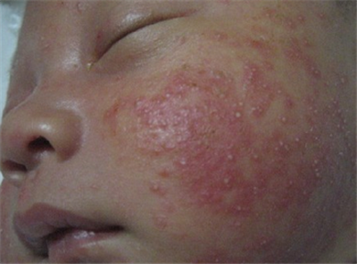 新生儿湿疹如何处理