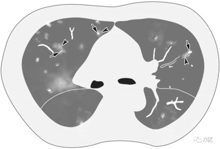 病毒性肺炎的影像学表现