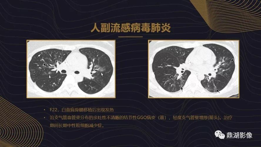 【ppt】病毒性肺炎的相关知识学习