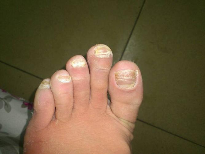 这是灰指甲吗?严重吗?