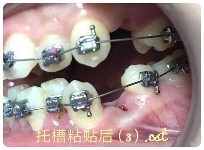 托槽粘贴后(3)