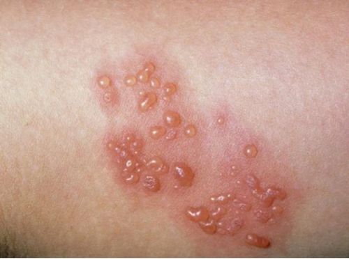 一名伤口师眼中的带状疱疹