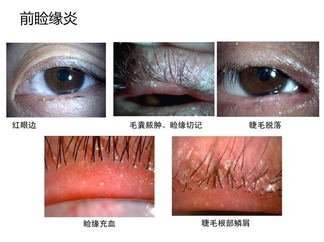 睑缘解剖与睑缘炎病理机理ppt