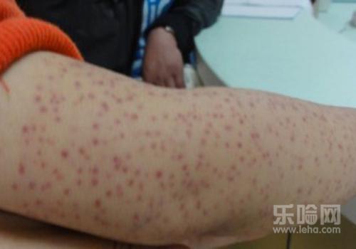 皮下出血点是什么原因