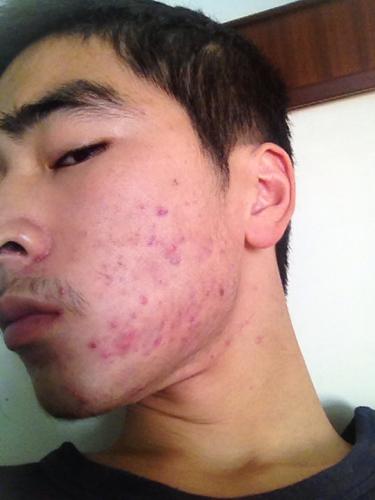 请问是红斑狼疮么