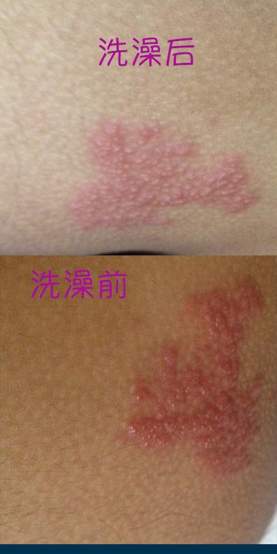 我屁股好似长水痘,又好似水泡,痒!请问是湿疹?还是水痘?