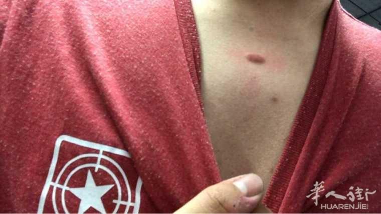 脖子下面长了个红肉痘痘摸上去软软的请问怎么消除