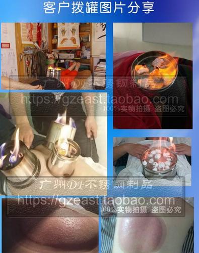 东方加厚不锈钢巨罐火罐家用扒火罐吸湿罐巨罐火罐不锈钢升阳罐