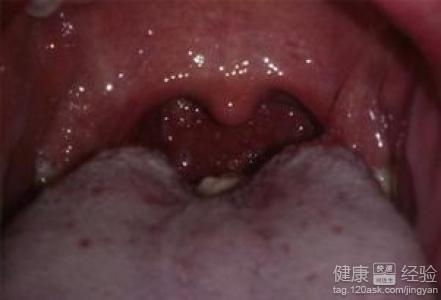 白喉中医叫什么