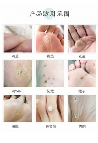 血泡刺专用膏鸡眼去猴子肉粒疙瘩瘊子神器鱼休子非药去根脚底正品