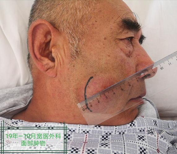 面部肿物(皮脂腺囊肿)切除