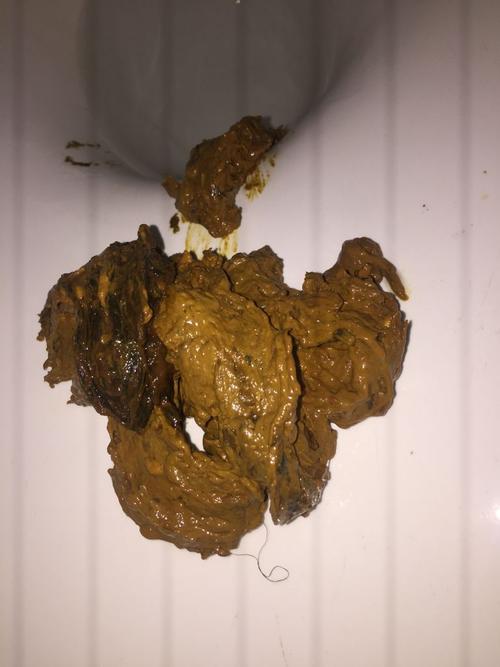 请问这像是艾滋病腹泻症状的大便吗?