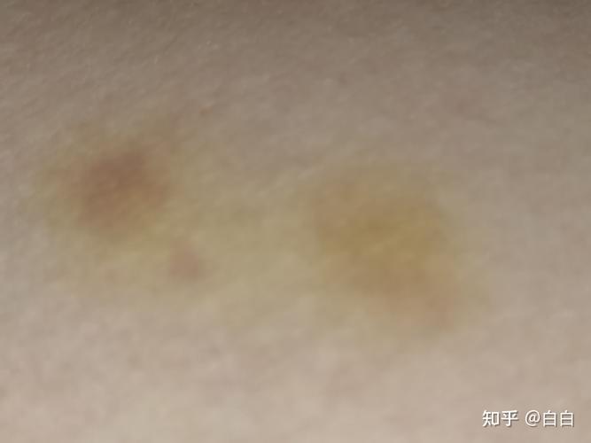 皮肤突然出现黄块