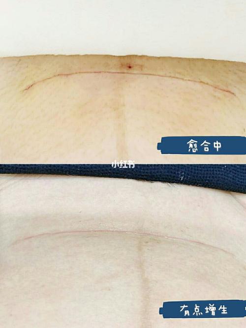 剖腹产后个月,成功淡化疤痕