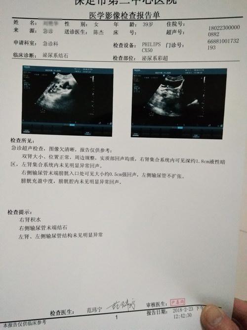 五绝指针治疗右侧输尿管末端结石