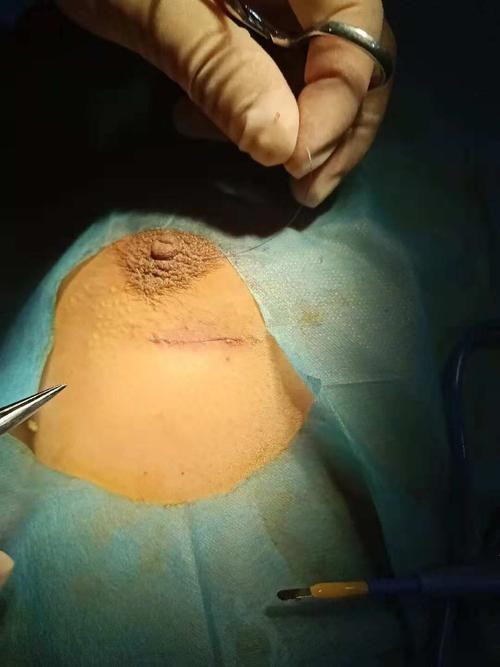 切口美容缝合,结合医用胶粘合,使患者无明显切口瘢痕,可保持乳房美观