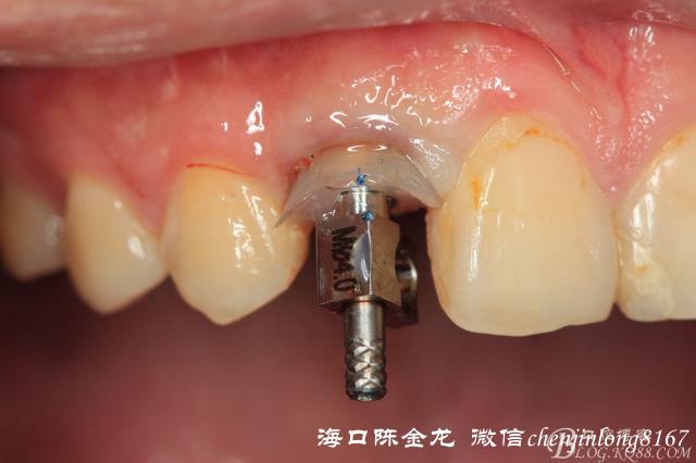 全套流程详细分解--前牙美学种植的个性化转移和粘接代型的制作