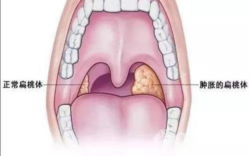 什么是腺样体肥大和扁桃体肥大?