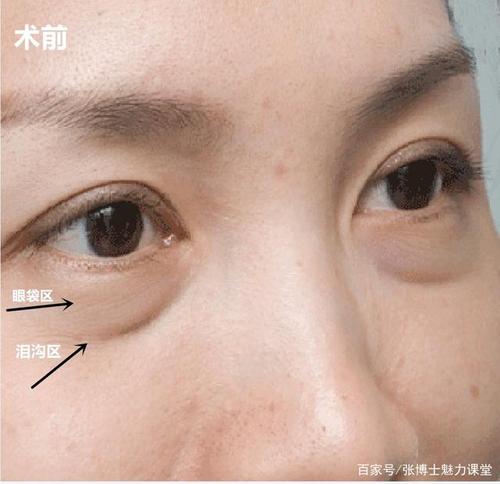 如何区分眼袋还是泪沟?
