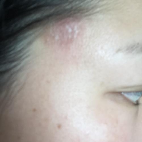 鬓角长了一块癣 偶尔会痒