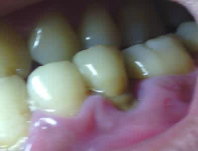 牙龈萎缩牙根外露图片儿童牙龈萎缩牙根外露图片