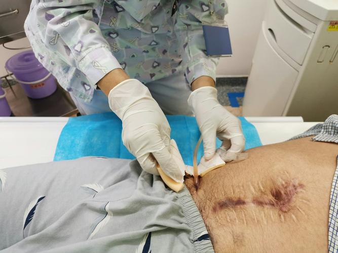 膀胱造瘘术后的护理及注意事项