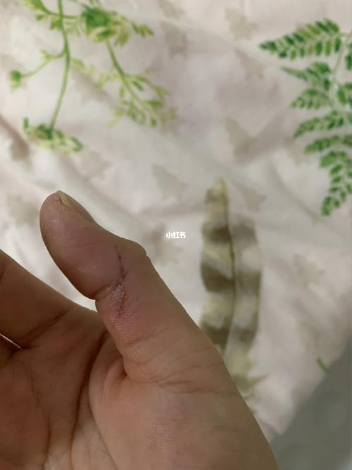 刀片割到手指后续_拍照_修眉刀_医疗健康_医疗健康其他