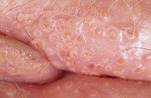 pictures of02genital herpes – female