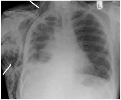 图文详解丨气胸的影像学表现