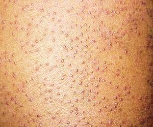 科学认识毛囊角化症是怎么一回事