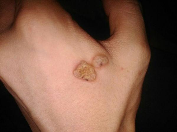 治疗手指上的寻常疣(鱼鳞痣)有什么办法,或者药物?