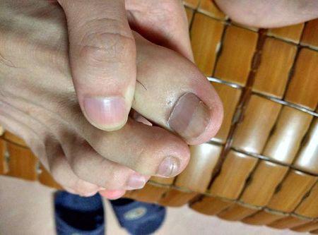 脚指甲出现波浪的凹横 什么原因