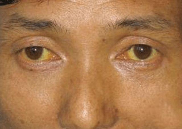 患有乙肝平时少吃这2物多喝这2水或有助于养肝护肝