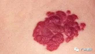 毛细血管瘤有哪些危害呢