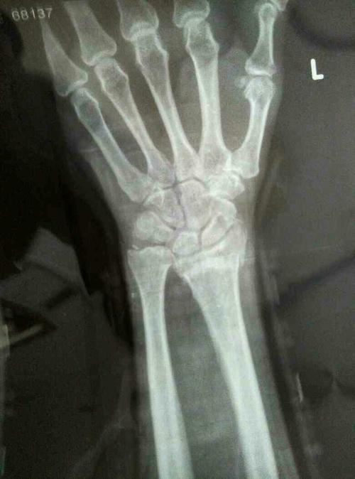 左手桡骨远端骨折50天了,10天前松了夹现在拿东西痛,手掌支地90度也痛