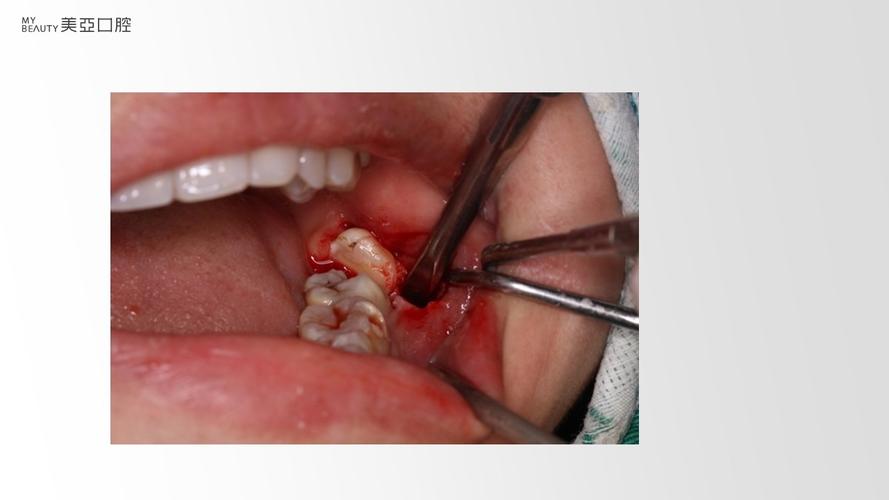 埋伏阻生牙拔除术分享